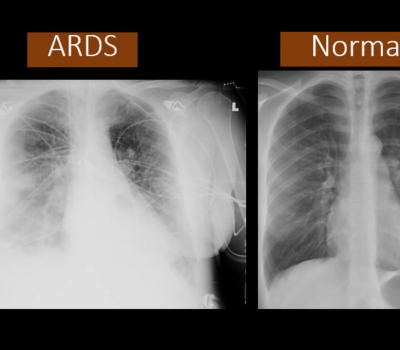 This YouTube screenshot shows how the chest x-ray of a person with acute respiratory distress syndrome—a condition caused by COVID-19—compares with that of someone with normal lungs. Abnormal medical imaging of the lungs is among the red flags the Defense Department looks out for when determining whether individuals are medically qualified to enlist. Video screenshot via Dr. on YouTube.