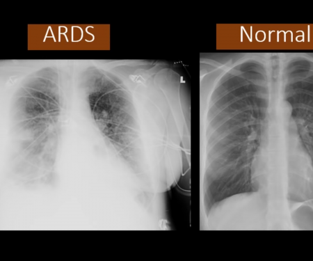 This YouTube screenshot shows how the chest x-ray of a person with acute respiratory distress syndrome—a condition caused by COVID-19—compares with that of someone with normal lungs. Abnormal medical imaging of the lungs is among the red flags the Defense Department looks out for when determining whether individuals are medically qualified to enlist. Video screenshot via Dr. on YouTube.