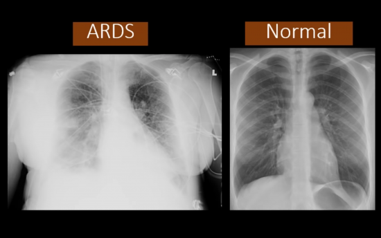 This YouTube screenshot shows how the chest x-ray of a person with acute respiratory distress syndrome—a condition caused by COVID-19—compares with that of someone with normal lungs. Abnormal medical imaging of the lungs is among the red flags the Defense Department looks out for when determining whether individuals are medically qualified to enlist. Video screenshot via Dr. on YouTube.