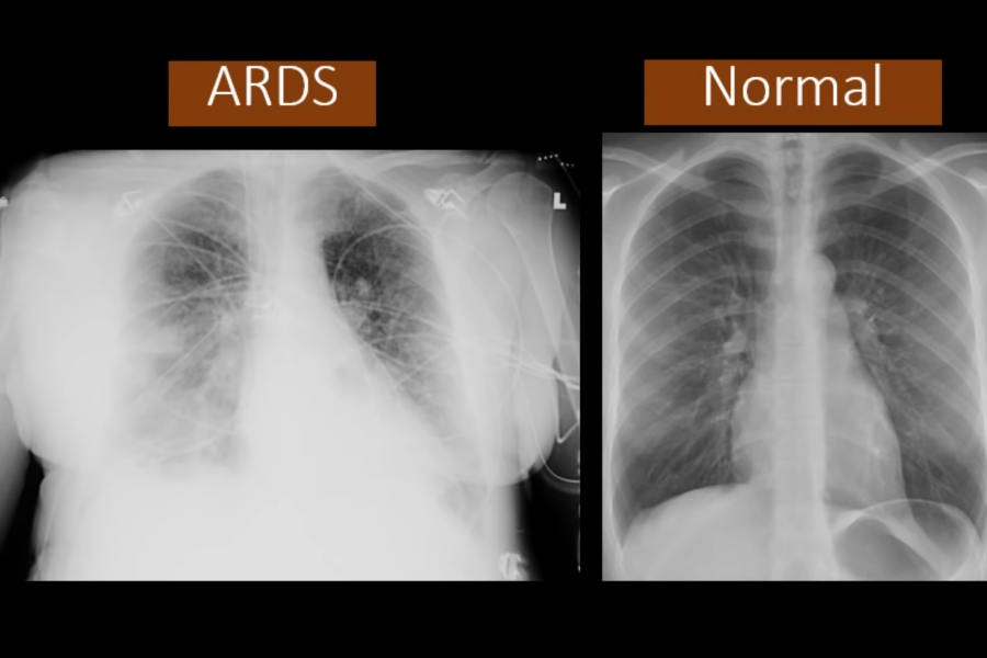 This YouTube screenshot shows how the chest x-ray of a person with acute respiratory distress syndrome—a condition caused by COVID-19—compares with that of someone with normal lungs. Abnormal medical imaging of the lungs is among the red flags the Defense Department looks out for when determining whether individuals are medically qualified to enlist. Video screenshot via Dr. on YouTube.